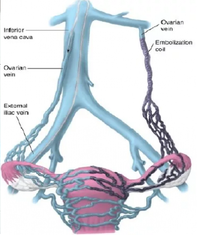 varicose veins of the pelvis